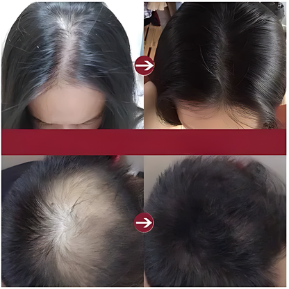 BIOTIN SHAMPOO MINOXIDIL 5% – Frena la caída y estimula el crecimiento desde la raíz