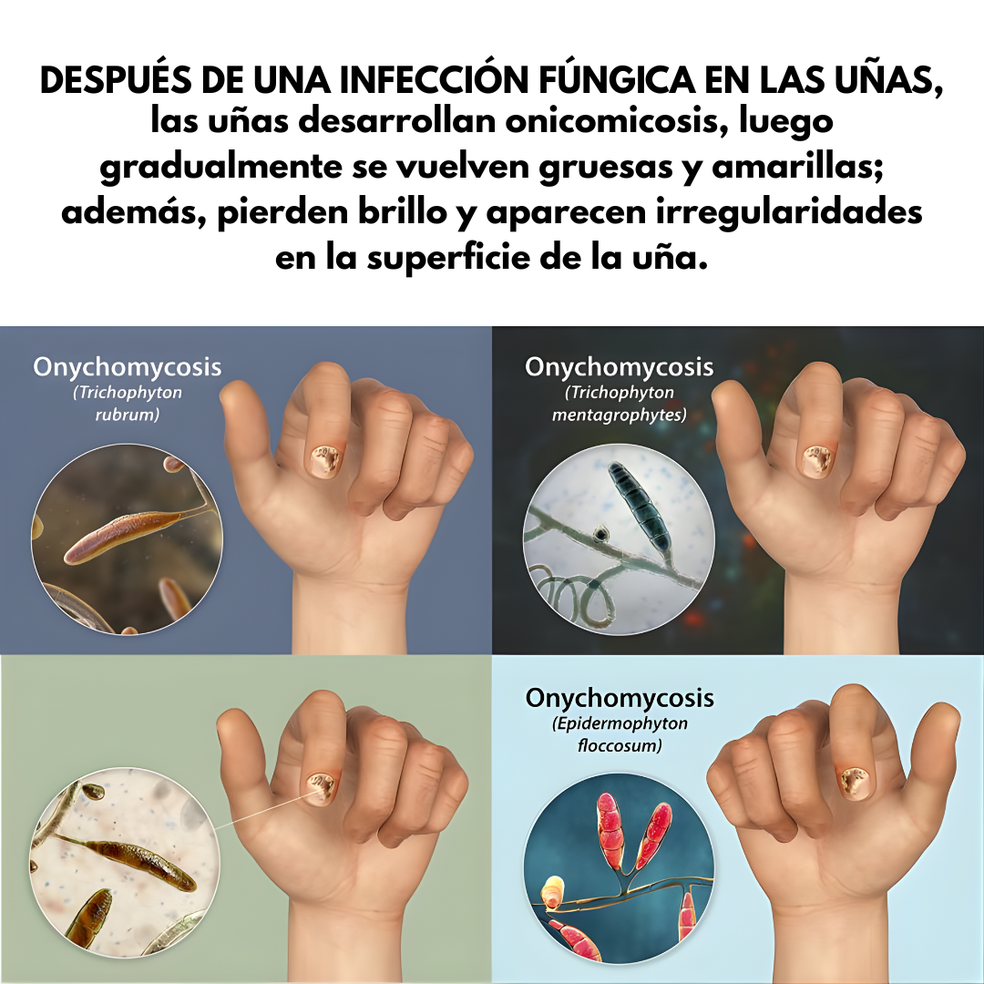QUITA HONGOS UÑAS – Elimina el hongo, regenera y fortalece tus uñas desde la raíz