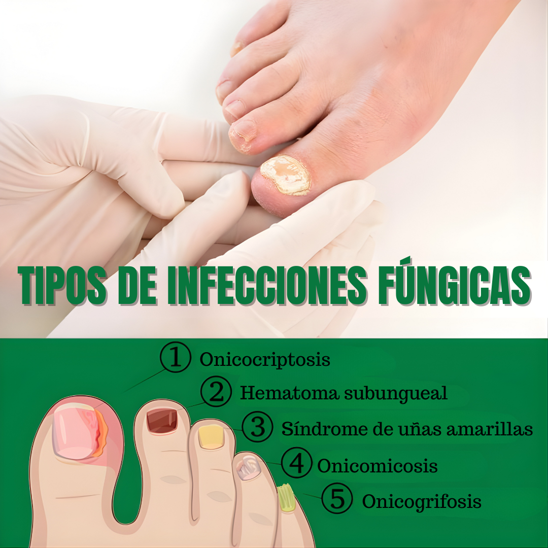 QUITA HONGOS UÑAS – Elimina el hongo, regenera y fortalece tus uñas desde la raíz